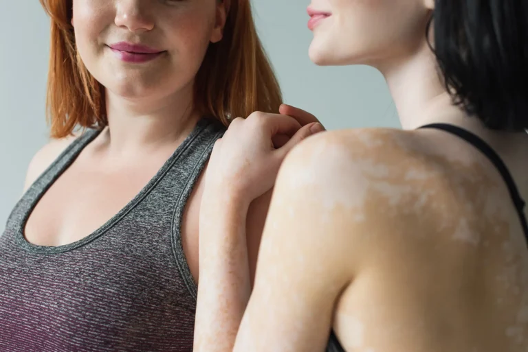 Skin Pigmentation treatment
