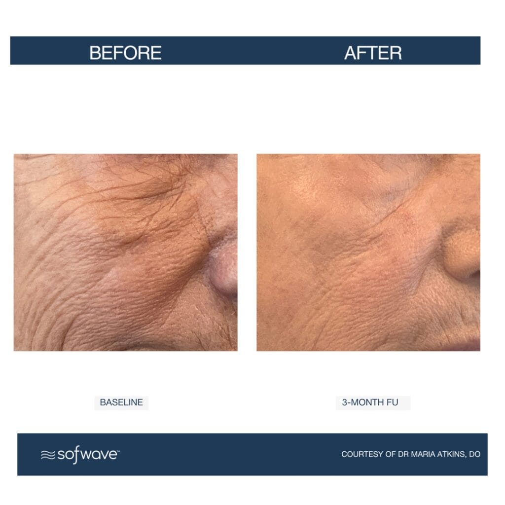Sofwave vs Ultherapy – Healthy Glow Aesthetics, Fort Lauderdale FL