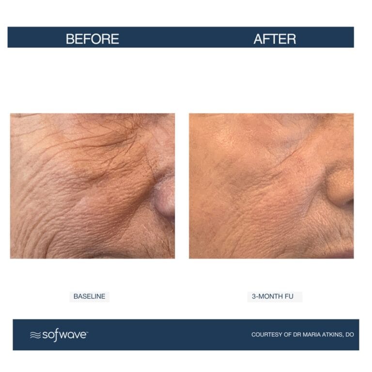Sofwave vs Ultherapy – Healthy Glow Aesthetics, Fort Lauderdale FL