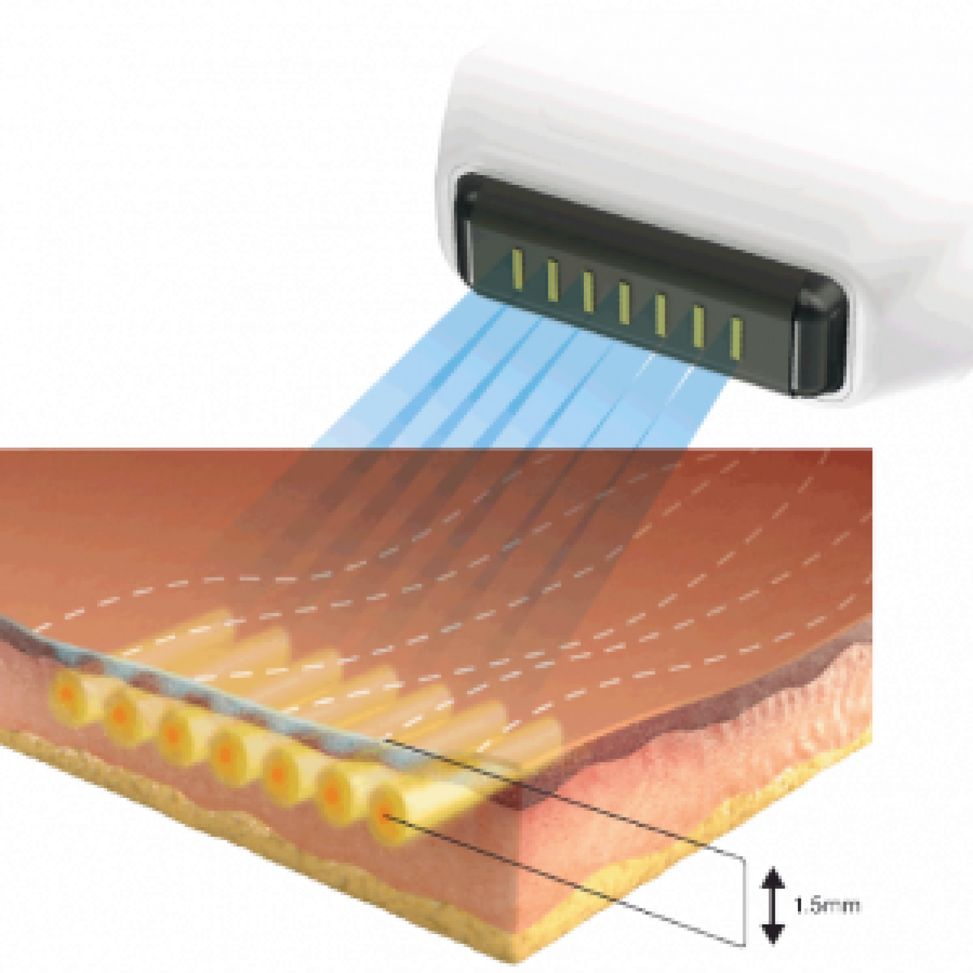 Sofwave vs Ultherapy at Healthy Glow Aesthetics in Fort Lauderdale
