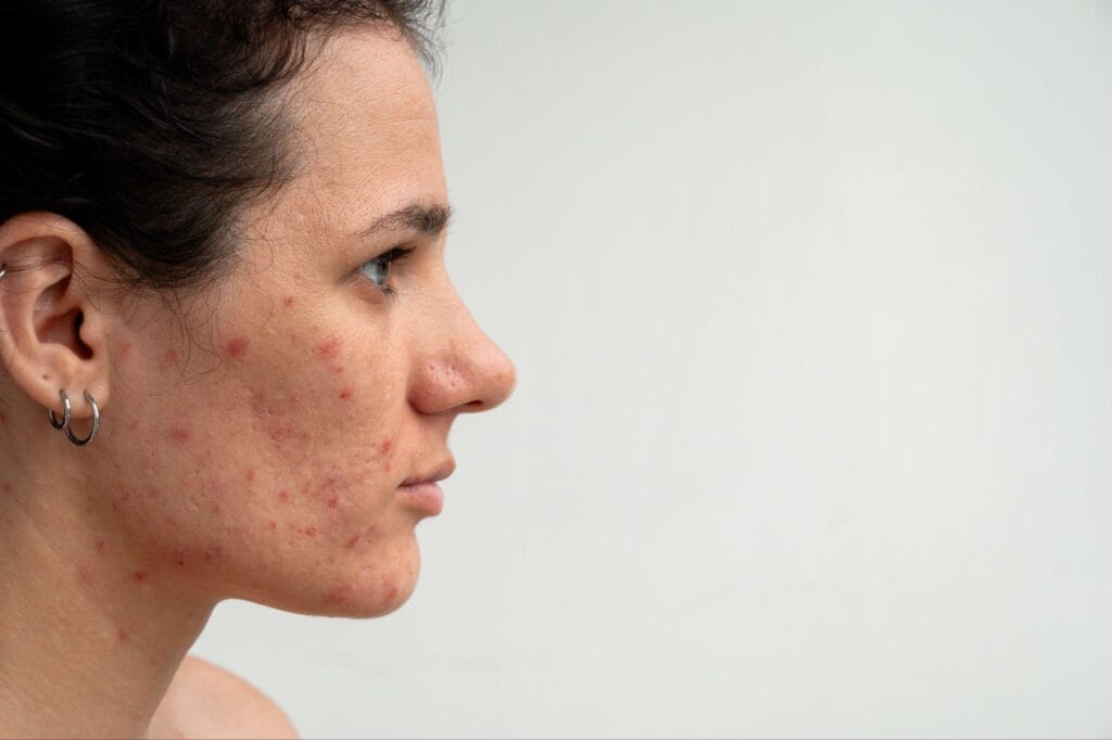 Effective Acne Treatment Facials in Fort Lauderdale – Healthy Glow Aesthetics, Fort Lauderdale FL