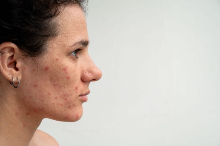 Effective Acne Treatment Facials in Fort Lauderdale – Healthy Glow Aesthetics, Fort Lauderdale FL