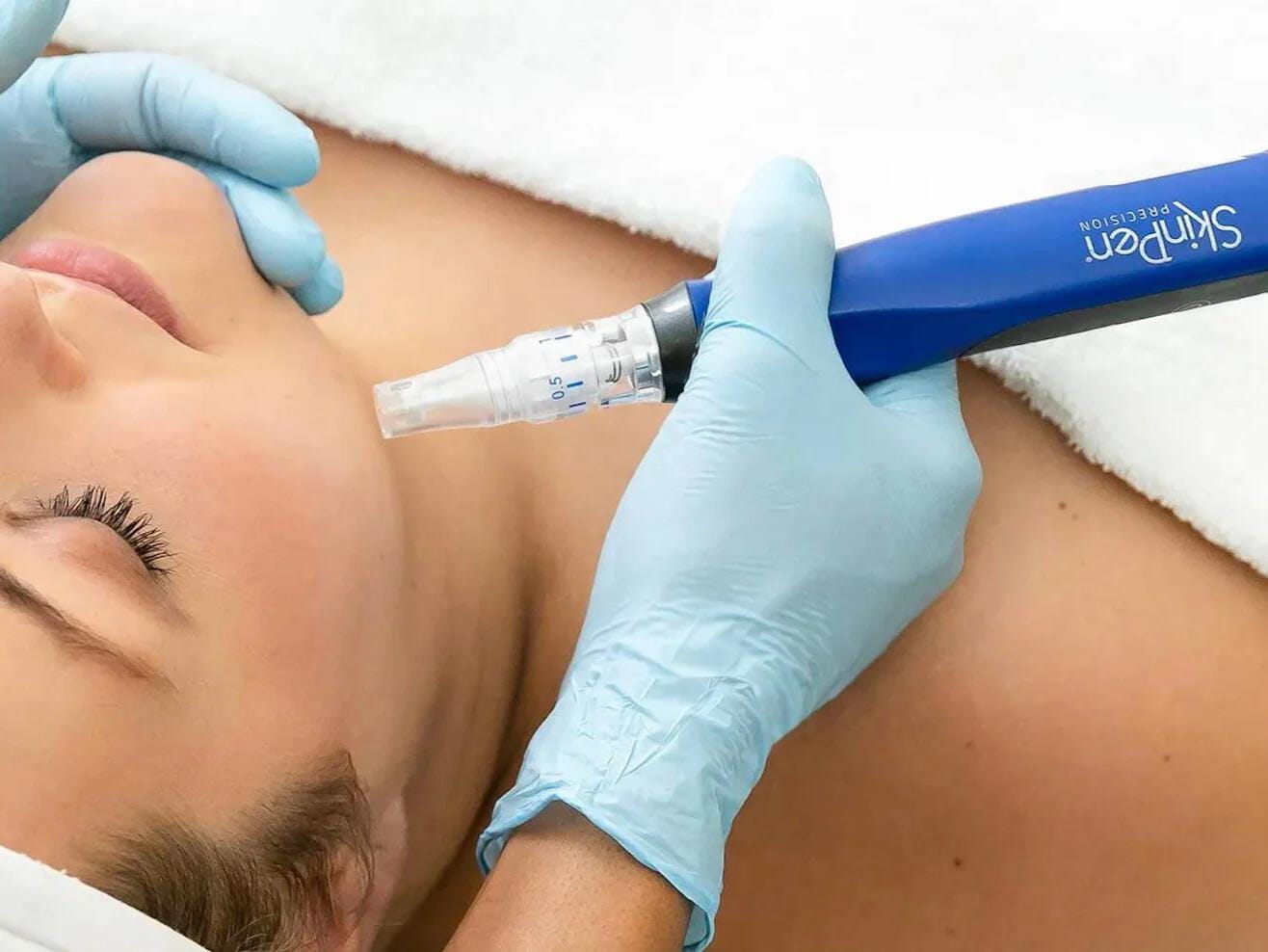 Microneedling for Acne Scars in Fort Lauderdale – Healthy Glow Aesthetics, Fort Lauderdale FL