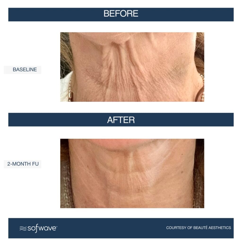 Sofwave Skin Rejuvenation in Fort Lauderdale – Healthy Glow Aesthetics, Fort Lauderdale FL