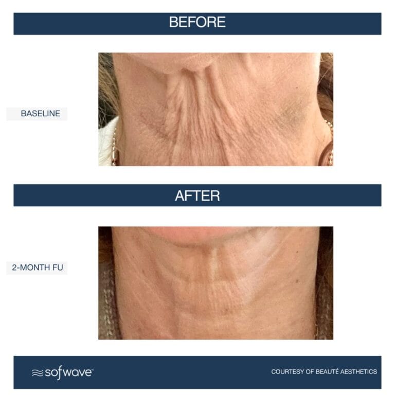 Sofwave Skin Rejuvenation in Fort Lauderdale – Healthy Glow Aesthetics, Fort Lauderdale FL